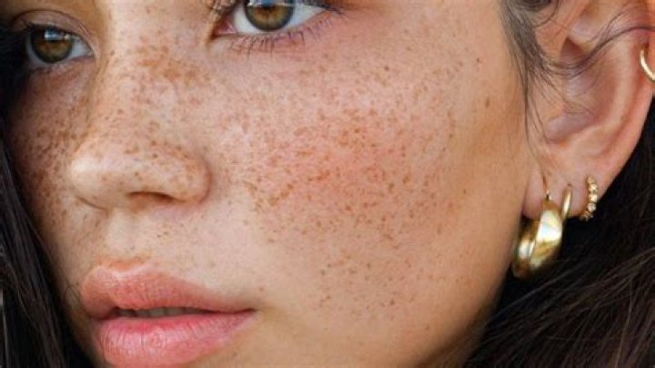 Are freckles attractive?