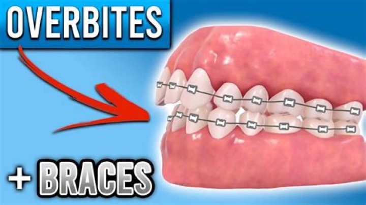 Do braces fix overbite?