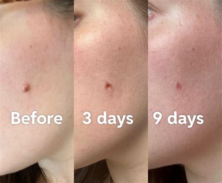 Do face moles grow?