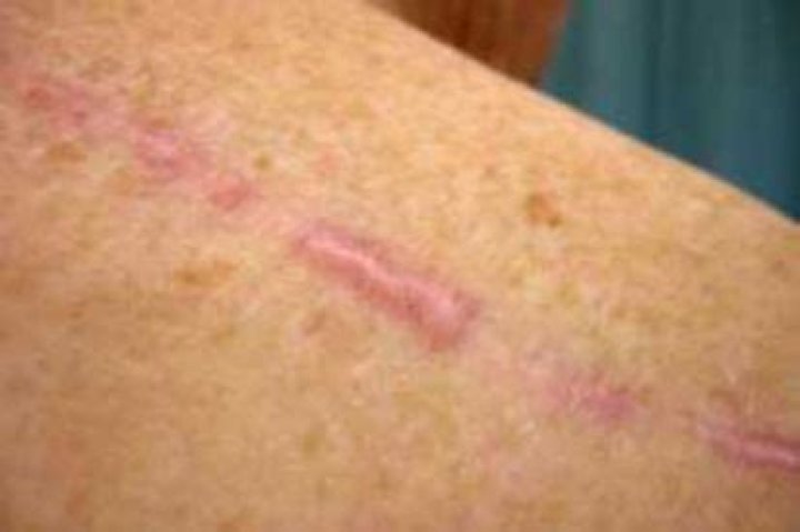 What's a keloid look like?