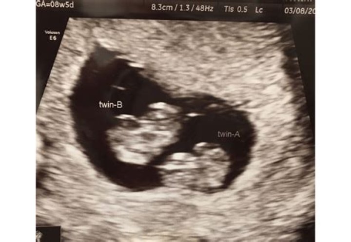 What are signs of twins at 8 weeks?