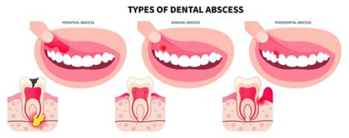 What is the difference between a tooth infection and an abscess?