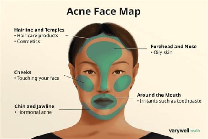 What percent of the world has acne?